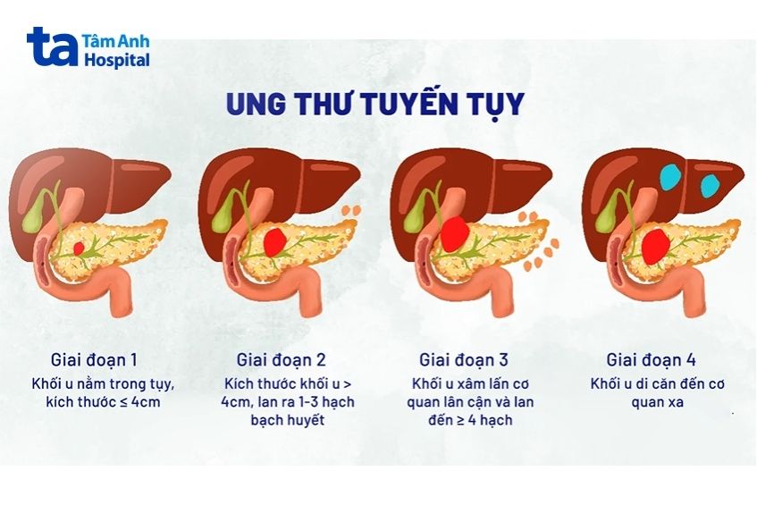 giai đoạn được phân loại bởi kích thước