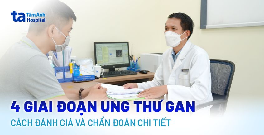 4 giai đoạn ung thư gan: Cách đánh giá và chẩn đoán chi tiết