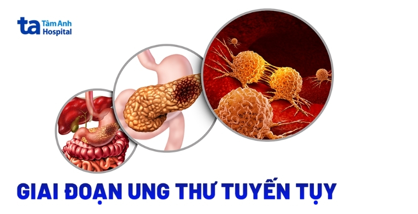5 giai đoạn ung thư tuyến tụy: Đánh giá và chẩn đoán chi tiết