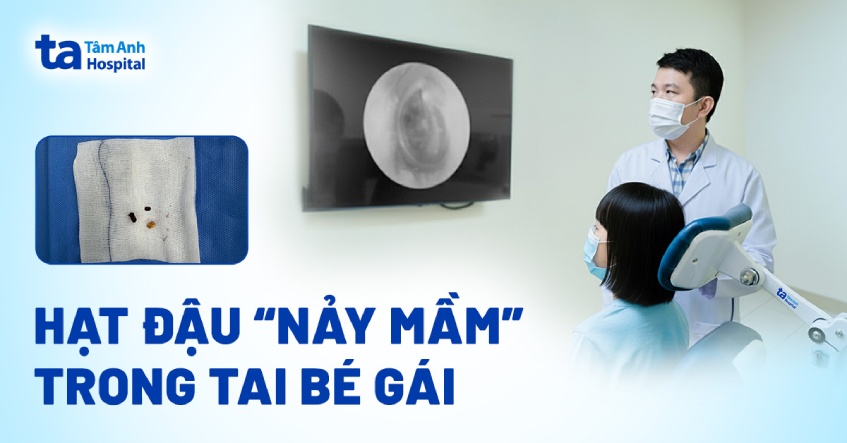Hạt đậu ‘nảy mầm’ trong tai bé gái