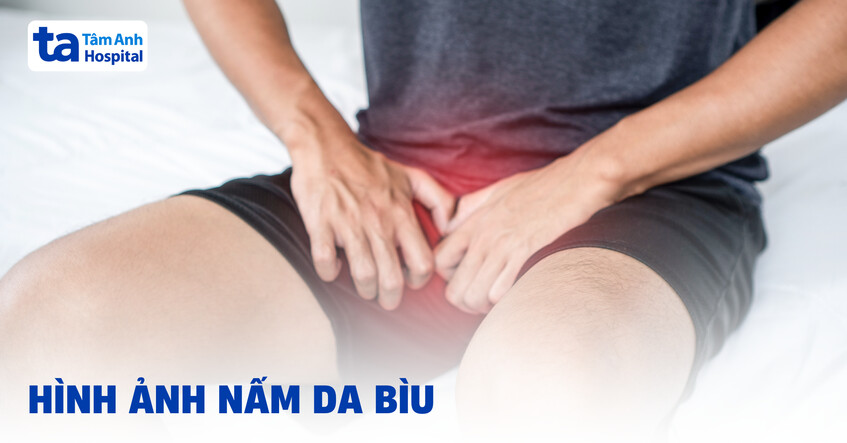 Nhận biết hình ảnh nấm da bìu kèm nguyên nhân, cách điều trị