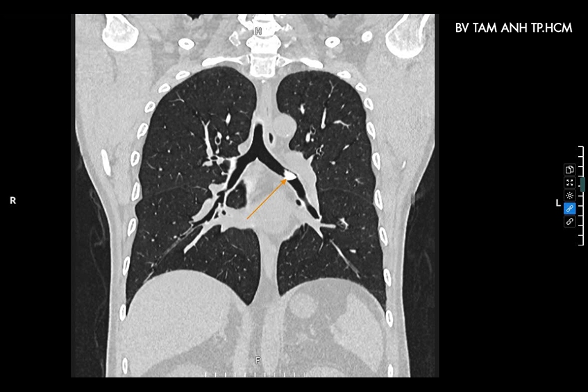 hình ảnh chụp ct cho thấy dị vật kẹt ở phế quản trái