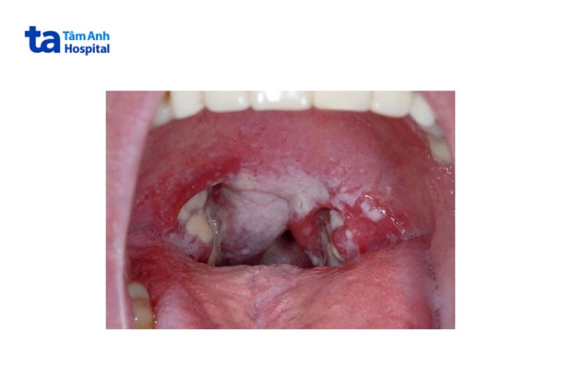 hình ảnh bệnh bạch hầu trên lâm sàng