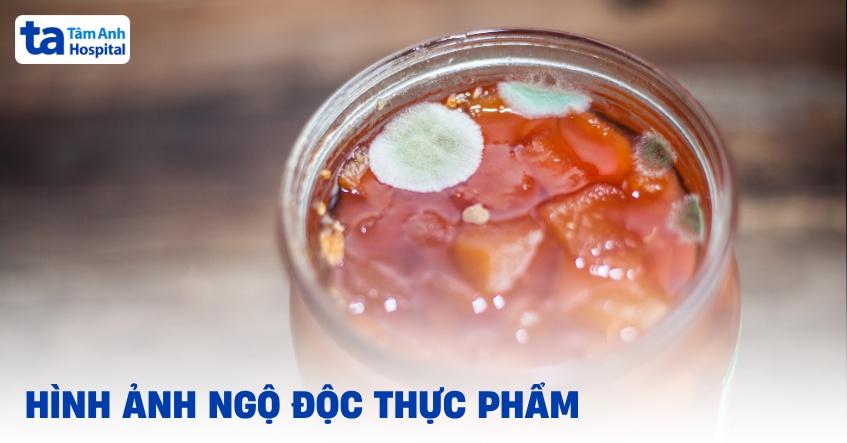 Hình ảnh ngộ độc thực phẩm dựa trên các nguyên nhân thường gặp
