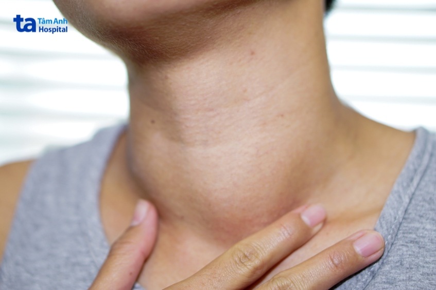 hình ảnh người bệnh bướu cổ có tuyến giáp phát triển lớn