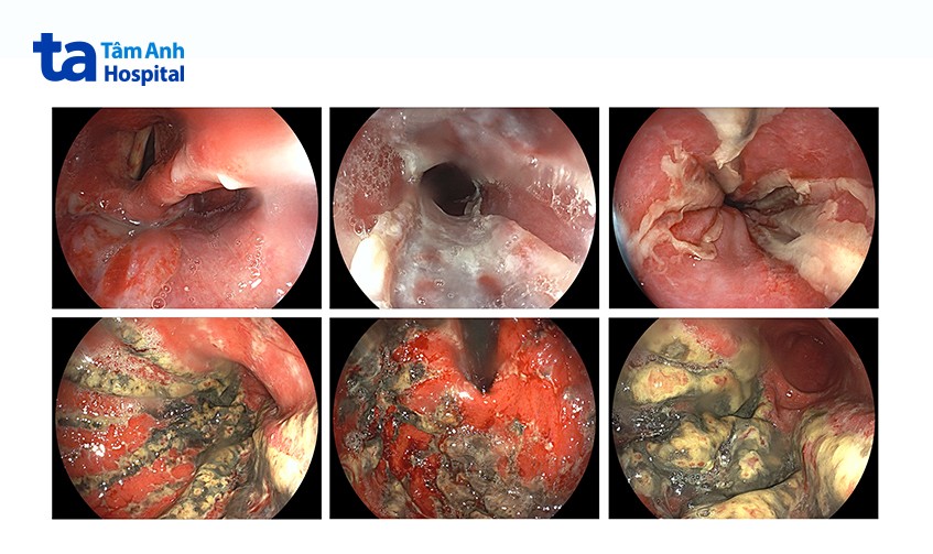 hình ảnh nội soi loét từ miệng đến dạ dày