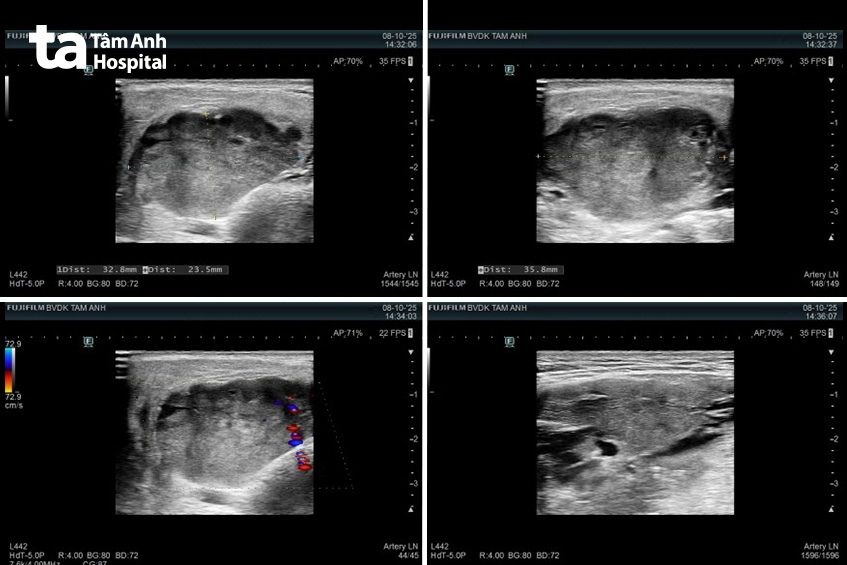 hình ảnh siêu âm khối u mang tai