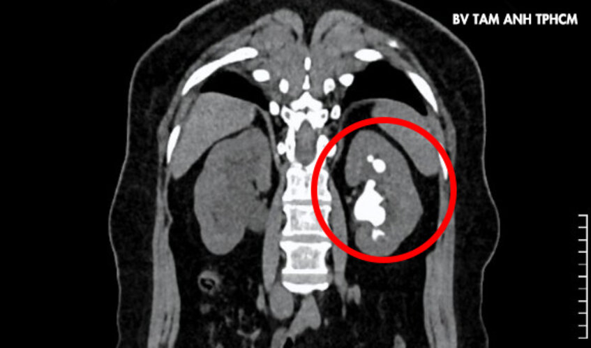 hình ảnh sỏi san hô