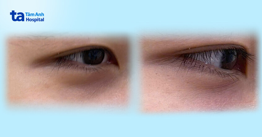 hình ảnh trước và sau khi tiêm