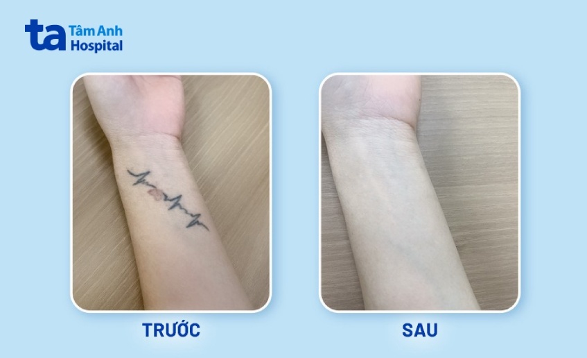 hình ảnh trước và sau khi xóa xăm