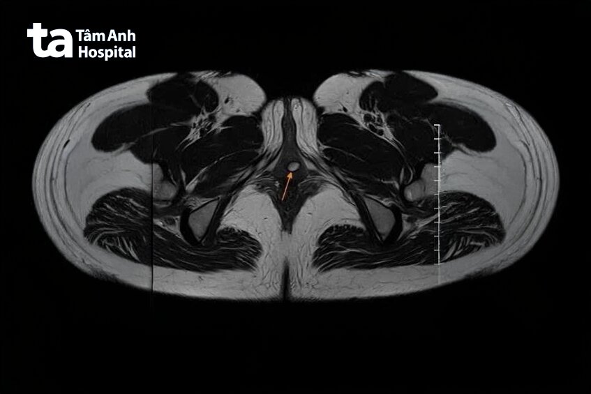 hình ảnh túi thừa trong niệu đạo bệnh nhân