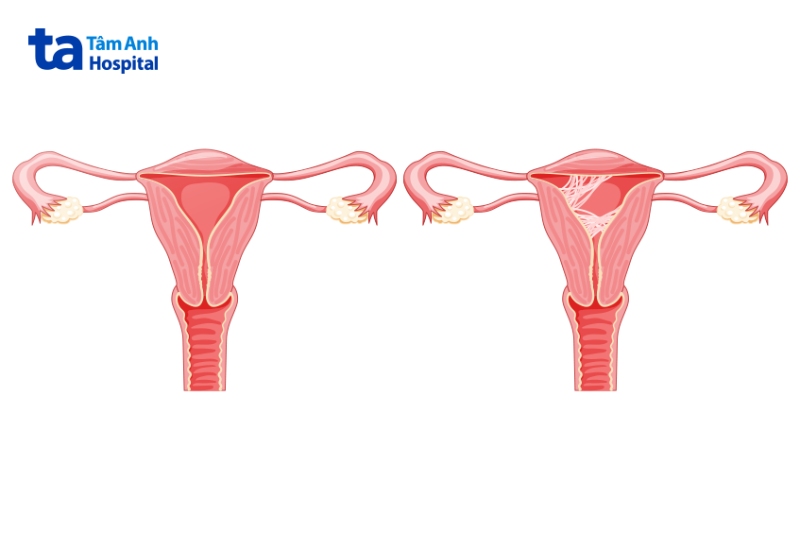 hình giải phẫu buồng trứng