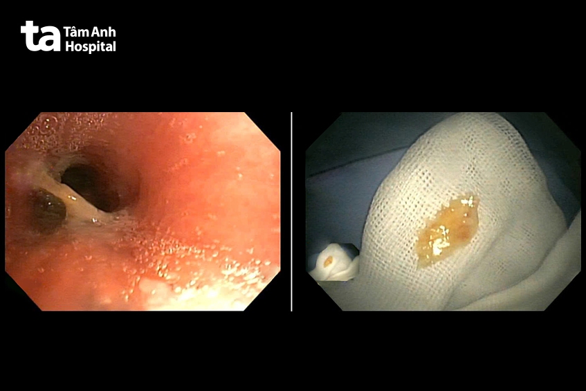 hình nội soi xương cá đâm ngang phế quản