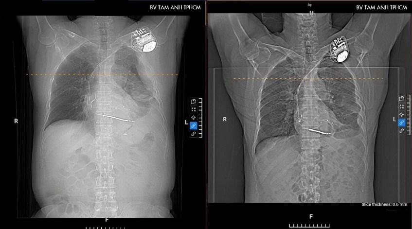 hình x-quang cho thấy tràn dịch màng phổi bên trái
