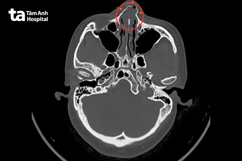 kết quả CT dị tháp mũi