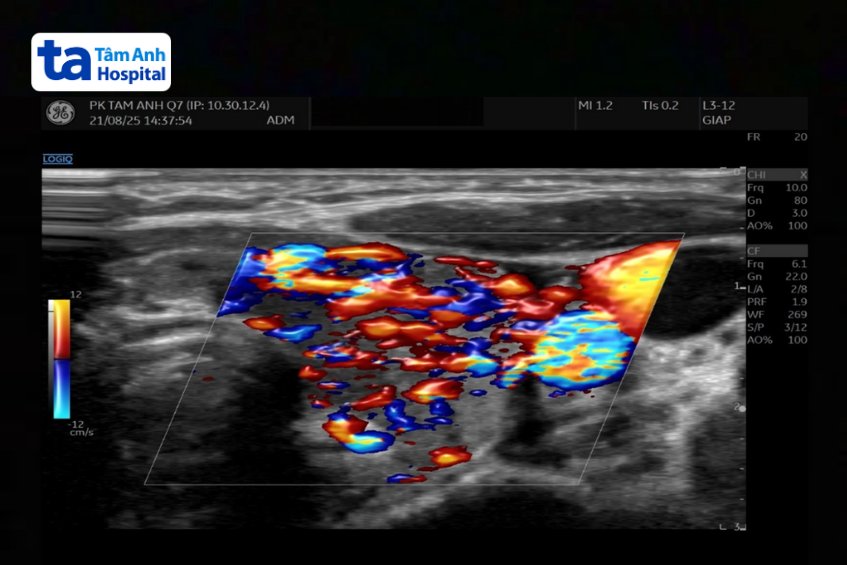 kết quả siêu âm cho thấy nhu mô tuyến giáp không đồng nhất