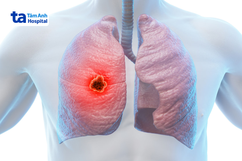 Hình ảnh khối u ác tính trong phổi trái được đánh dấu đỏ rõ nét