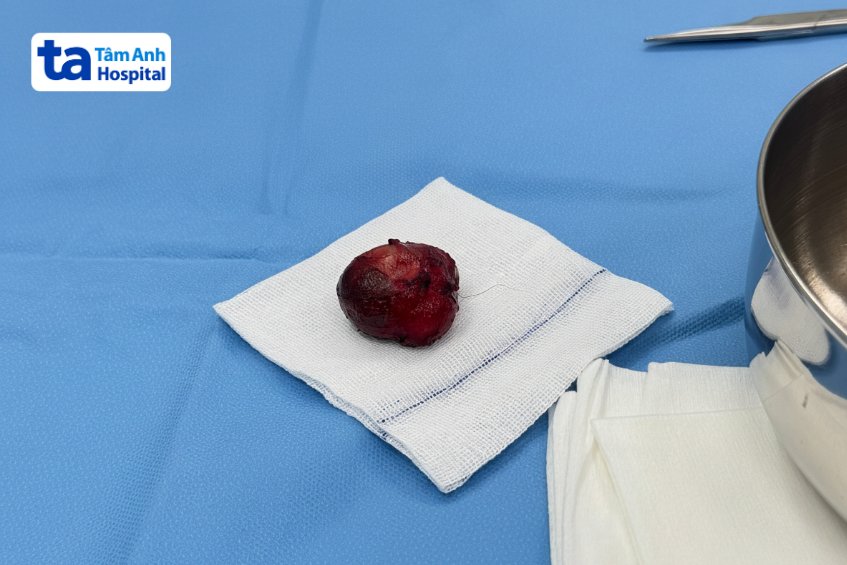 khối u bã đậu được bác sĩ phẫu thuật cắt bỏ thành công