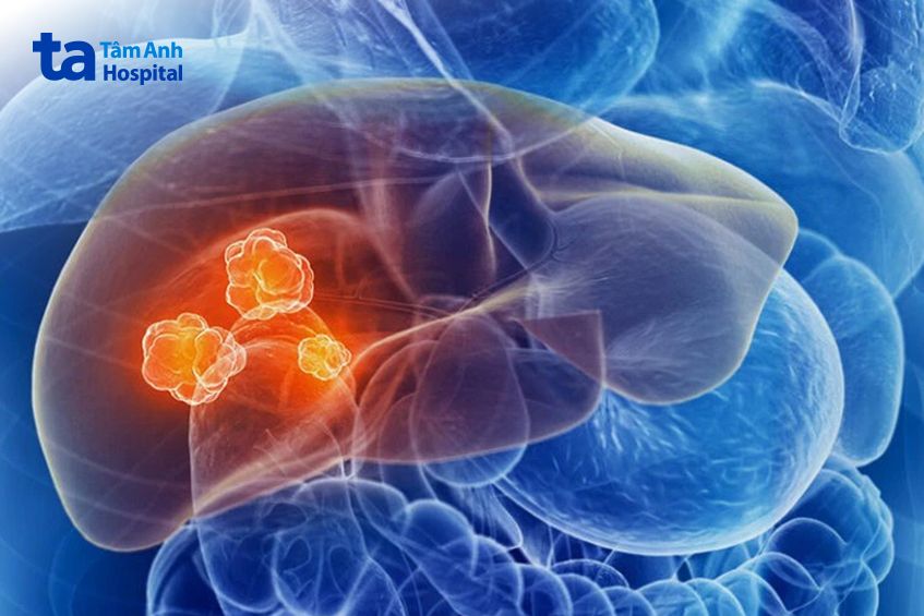 khối u chưa di căn xa