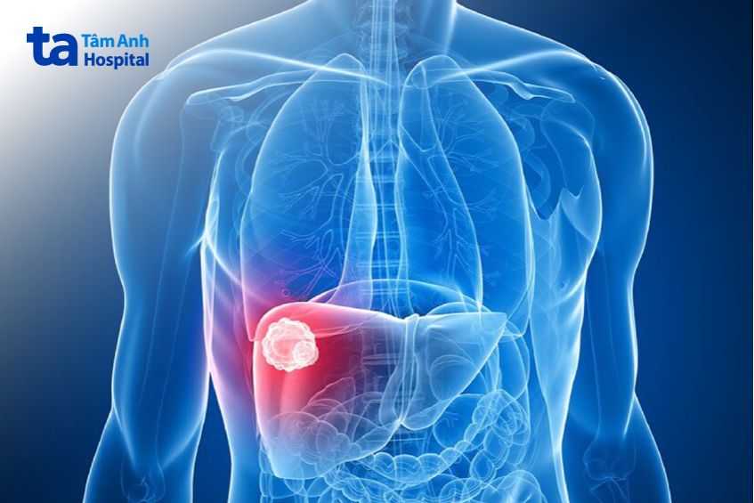 khối u di căn ở ung thư gan giai đoạn 4