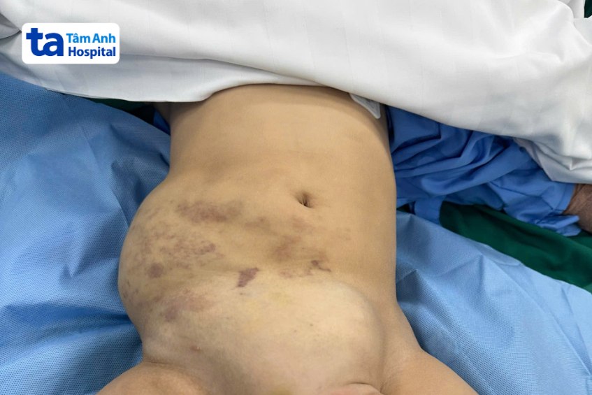 khối u to bằng 1 phần 3 cơ thể chèn ép bụng bệnh nhi