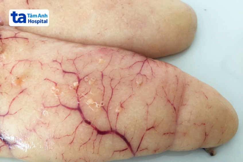 ký sinh trùng trong cá tuyết trứng