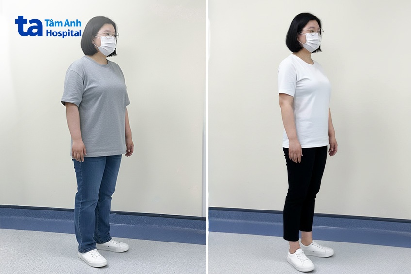 lê giảm 25kg sau hơn 4 tháng điều trị giảm cân. ảnh_ bệnh viện đa khoa tâm anh