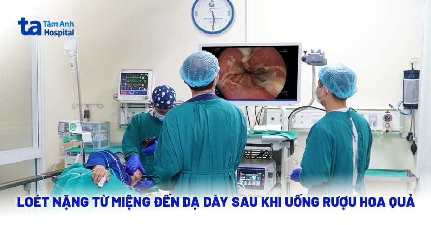 Loét nặng từ miệng đến dạ dày sau khi uống rượu hoa quả