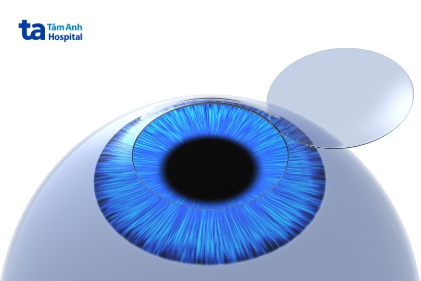 Lợi ích và rủi ro của công nghệ Laser Excimer