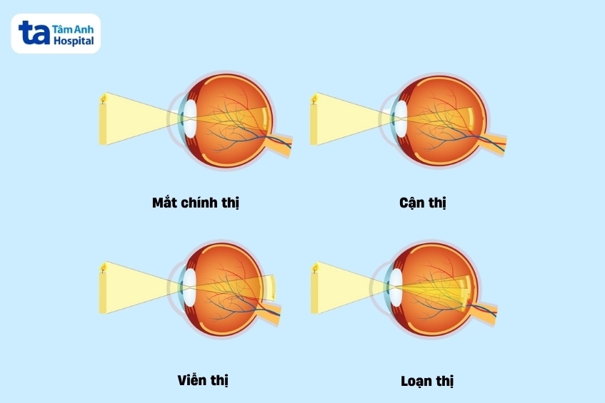 Mắt chính thị và các tật khúc xạ