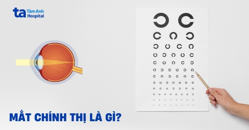 Mắt chính thị là gì? Có phải mắt hoàn hảo?