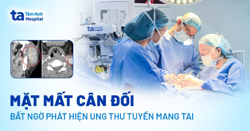 Mặt mất cân đối, bất ngờ phát hiện ung thư tuyến mang tai