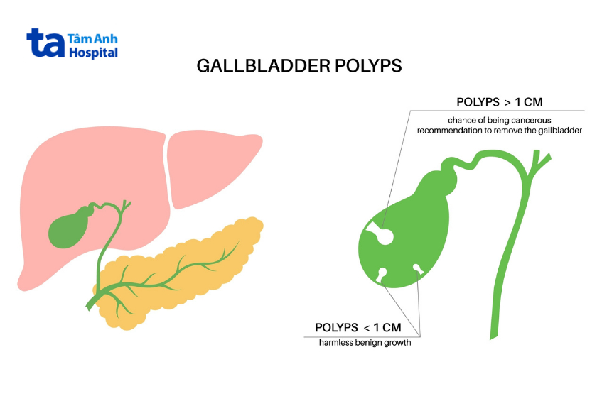Hình minh họa phân biệt polyp túi mật <1cm là lành tính, >1cm cần lưu ý