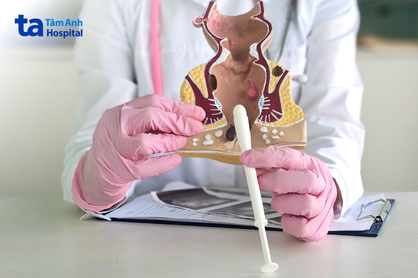 Mô hình hậu môn với bác sĩ minh họa cách sử dụng dụng cụ đặt thuốc trị trĩ