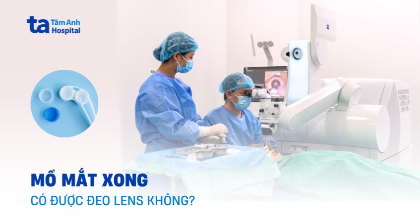 Mổ mắt xong có được đeo lens không? Bao lâu thì đeo được?