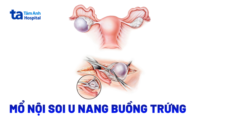 Có nên chọn mổ nội soi u nang buồng trứng?