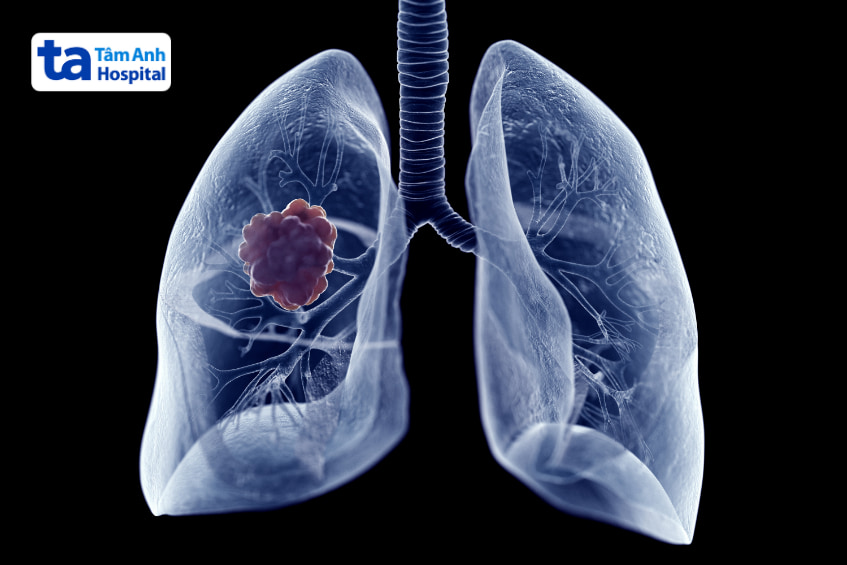 Mô phỏng 3D khối u xuất hiện trong phổi với nền đen nổi bật