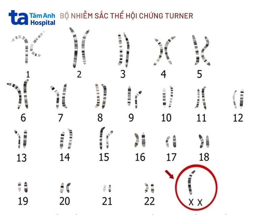 mô phỏng nhiễm sắc thể bị lỗi của hội chứng turner
