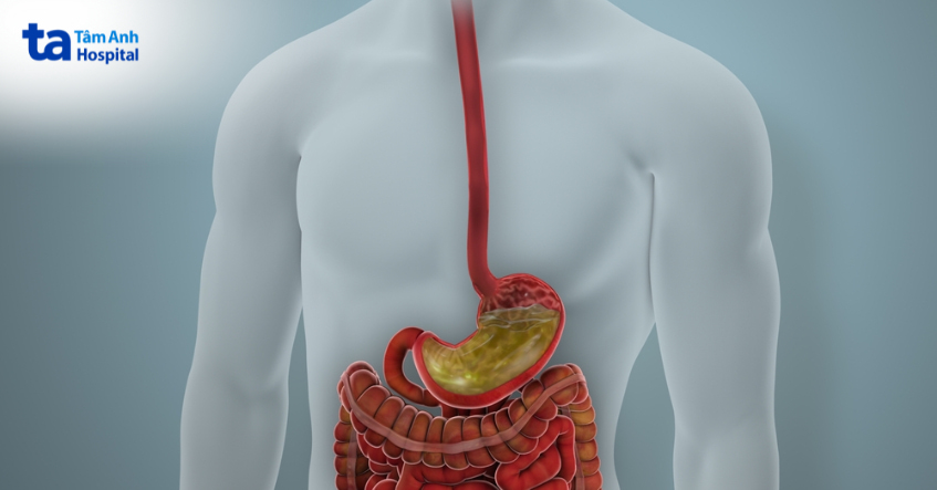 Mô phỏng hệ tiêu hóa với dạ dày tiết acid, liên quan đến bệnh trào ngược.