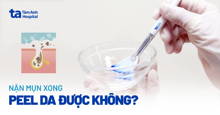 Vừa nặn mụn xong peel da được không?