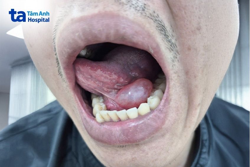 nang nhái sàn miệng gây khó ăn