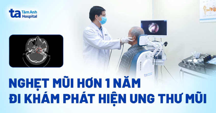 Nghẹt mũi hơn 1 năm, đi khám phát hiện ung thư mũi
