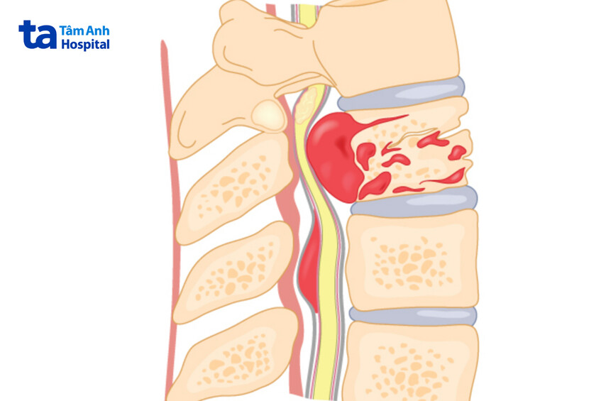 nguy cơ liệt vĩnh viện nếu không giải áp kịp thời