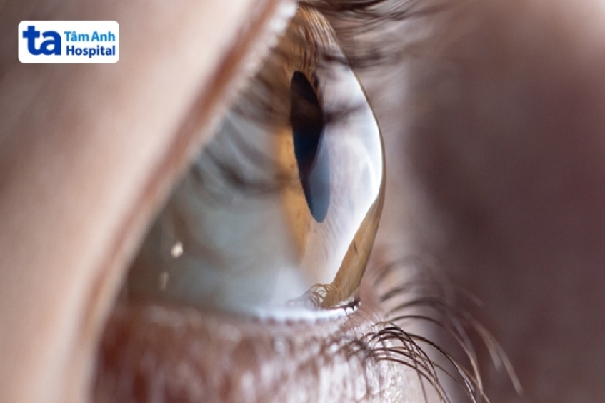 Nguyên nhân gây ra tật khúc xạ bẩm sinh