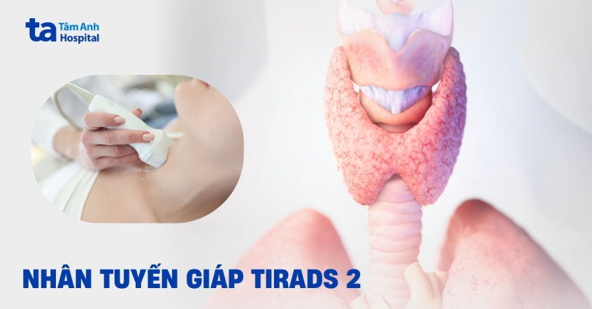 Nhân tuyến giáp TIRADS 2 có nghiêm trọng không?