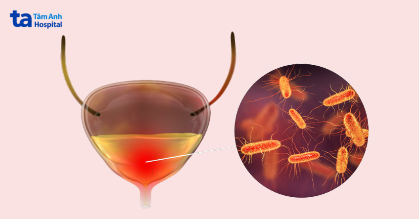 Hình minh họa nhiễm trùng bàng quang do vi khuẩn E.coli gây ra.