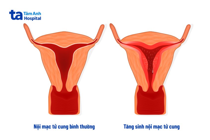 nhiều yếu tố ảnh hường đến độ dày nội mạc