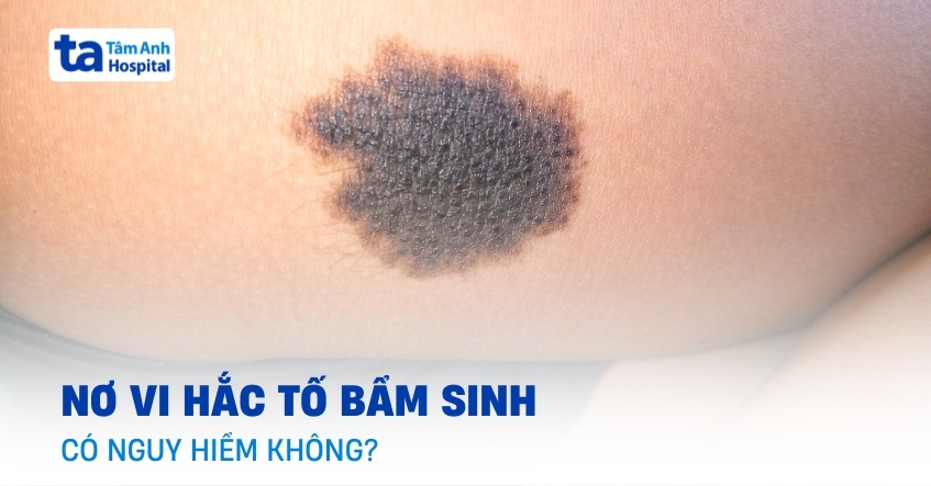 Nơ vi hắc tố bẩm sinh: Vì sao nên khám sớm?