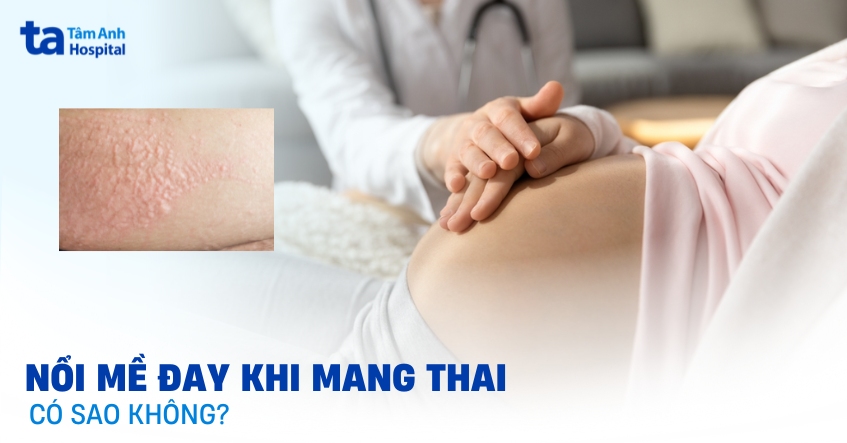 Giải đáp nhanh: Nổi mề đay khi mang thai có sao không?