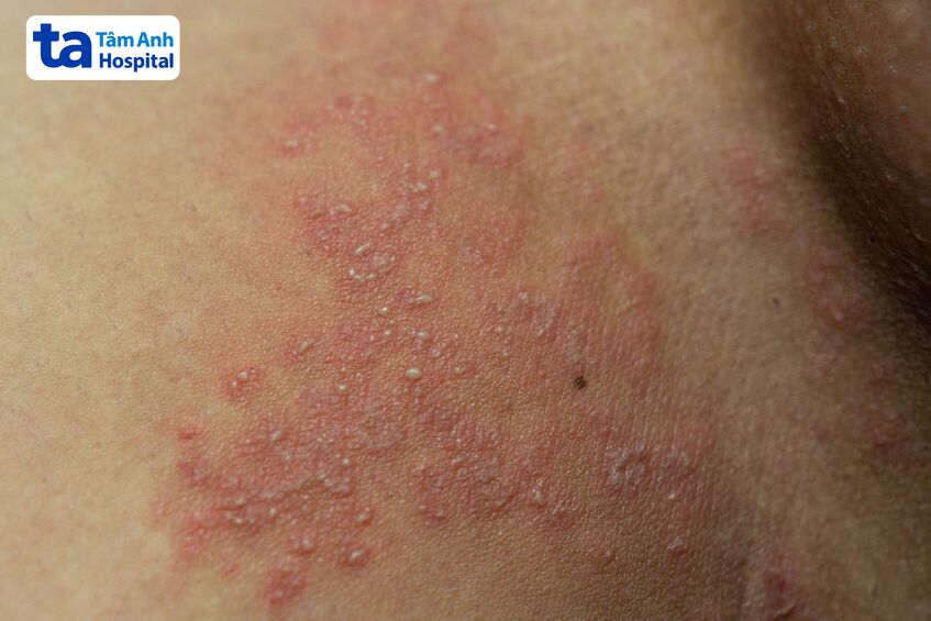 Nốt phát ban, bong vảy da do nấm ở bìu gây ngứa nhiều kèm cảm giác đau nhức, khó chịu